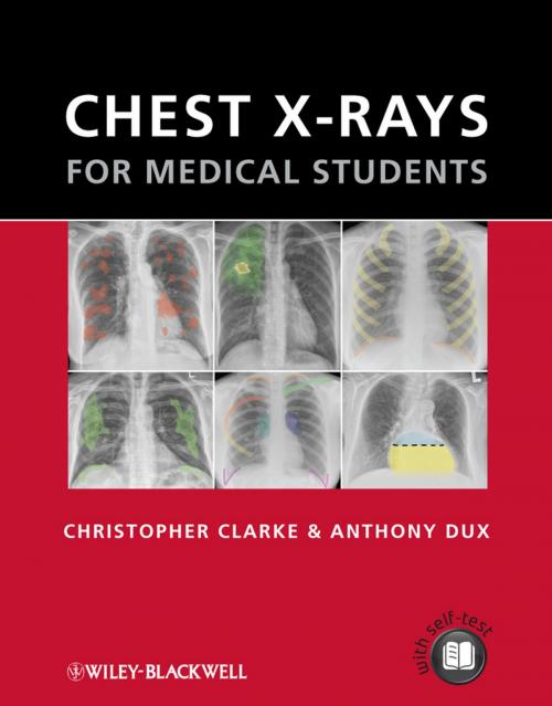 Cover of the book Chest X-rays for Medical Students by Christopher Clarke, Anthony Dux, Wiley