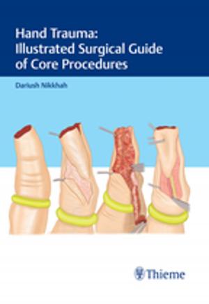 Cover of the book Hand Trauma: Illustrated Surgical Guide of Core Procedures by Jan Koolman, Klaus Heinrich Roehm