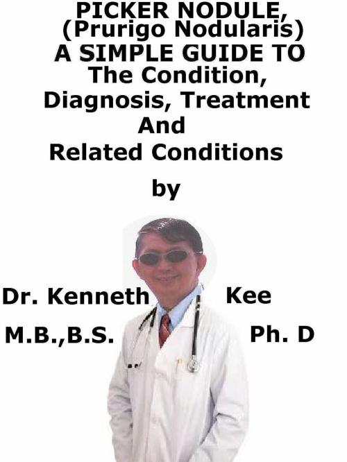 Cover of the book Picker Nodule, (Prurigo Nodularis) A Simple Guide To The Condition, Diagnosis, Treatment And Related Conditions by Kenneth Kee, Kenneth Kee