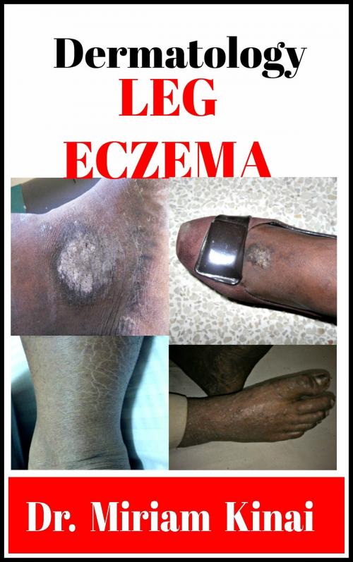 Cover of the book Dermatology: Leg Eczema by Miriam Kinai, Miriam Kinai