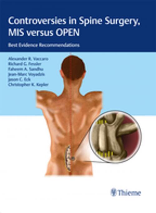 Cover of the book Controversies in Spine Surgery, MIS versus OPEN by , Thieme