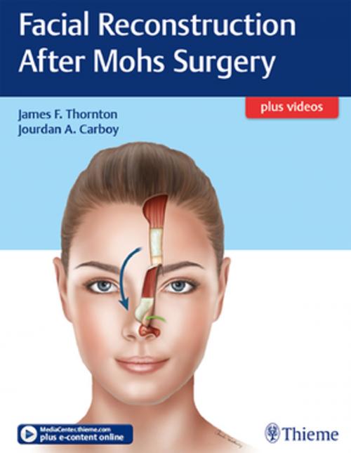 Cover of the book Facial Reconstruction After Mohs Surgery by , Thieme