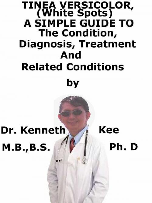 Cover of the book Tinea Versicolor, (White Spots) A Simple Guide To The Condition, Diagnosis, Treatment And Related Conditions by Kenneth Kee, Kenneth Kee