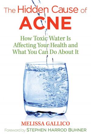 Cover of the book The Hidden Cause of Acne by Chris Klein